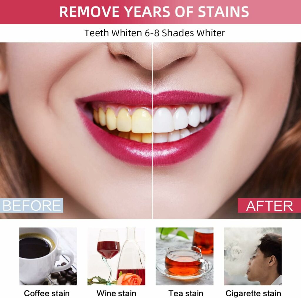 PDOO Teeth Whitening Kit with LED Light for Sensitive Teeth, Fast Results for Teeth Whitening at Home, Carbamide Peroxide Teeth Whitening Gel Helps Remove All Kinds of Stain PDOO Teeth Whitening Kit with LED Light for Sensitive Teeth, Fast Results for Teeth Whitening at Home, Carbamide Peroxide Teeth Whitening Gel Helps Remove All Kinds of Stain